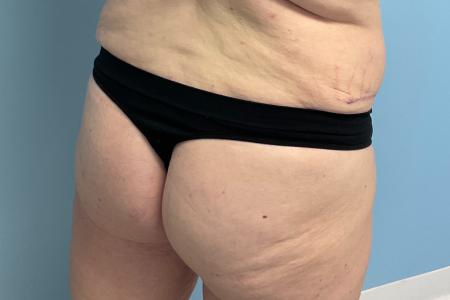 After image 1 Case #129256 - 38 y.o. with BBL through Fat Transfer