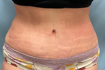 After image 1 Case #129086 - 50 y.o. female with Tummy Tuck