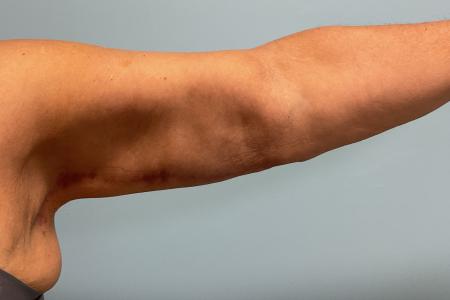 After image 1 Case #129191 - 58 y.o. female with Brachioplasty and Liposuction