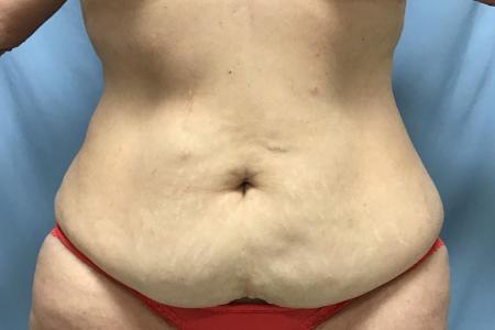 Before image 1 Case #129086 - 50 y.o. female with Tummy Tuck