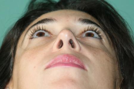 After image 6 Case #128881 - Primary Rhinoseptoplasty