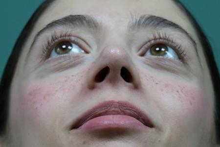 After image 6 Case #128876 - Primary Rhinoseptoplasty