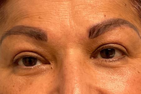 After image 1 Case #129891 - 61 y.o. female w/ Upper Blepharoplasty