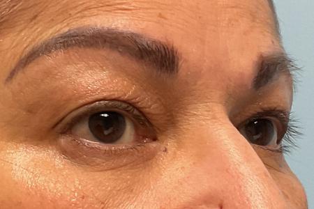 Before image 2 Case #129891 - 61 y.o. female w/ Upper Blepharoplasty