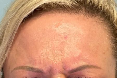 Before image 2 Case #129631 - 46 y.o. female with Botox