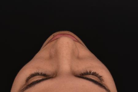 After image 6 Case #130026 - PRIMARY RHINOPLASTY