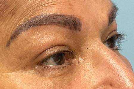 After image 2 Case #129891 - 61 y.o. female w/ Upper Blepharoplasty