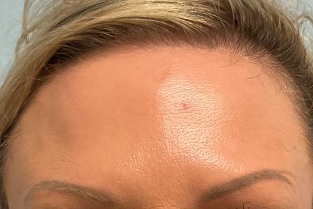 After image 1 Case #129631 - 46 y.o. female with Botox