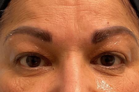 Before image 1 Case #129891 - 61 y.o. female w/ Upper Blepharoplasty