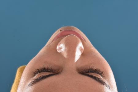 Before image 6 Case #130026 - PRIMARY RHINOPLASTY