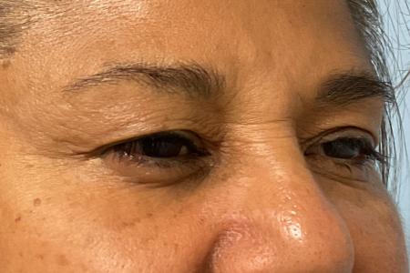 Before image 1 Case #129536 - 58 y.o. female w/ Upper Blepharoplasty