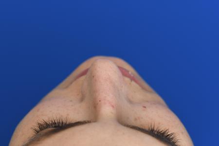 Before image 6 Case #129951 - RHINOPLASTY