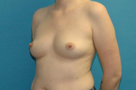Before image 2 Case #130286 - Breast Augmentation