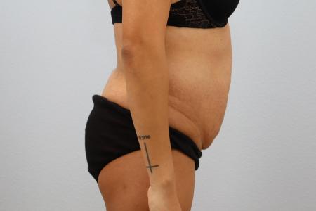 Before image 2 Case #130171 - Skin Removal Surgery: Tummy Tuck with Lipo 360