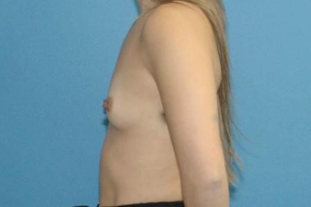 Before image 3 Case #130166 - Primary Breast Augmentation