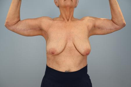 After image 1 Case #130191 - Arm Lift (Brachioplasty) – 6 Month Results