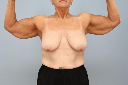 Before image 1 Case #130191 - Arm Lift (Brachioplasty) – 6 Month Results
