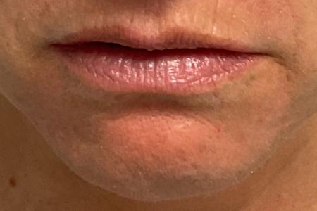 Before image 1 Case #130341 - 45 year old female with Lip Filler
