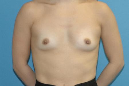 Before image 1 Case #130166 - Primary Breast Augmentation