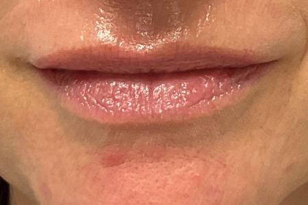 After image 1 Case #130341 - 45 year old female with Lip Filler