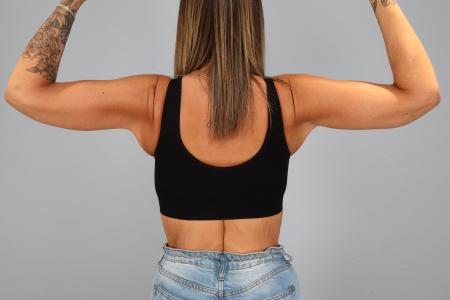 After image 2 Case #130531 - Arm Lift After Weightloss