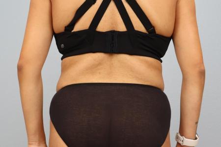 After image 3 Case #130171 - Skin Removal Surgery: Tummy Tuck with Lipo 360
