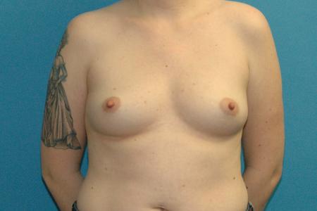 Before image 1 Case #130286 - Breast Augmentation