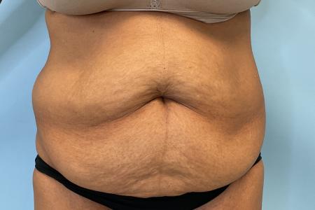 Before image 1 Case #131026 - 54 y.o. female with Tummy Tuck & Lipo of Flanks