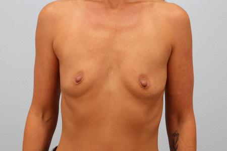 Before image 1 Case #130711 - 48 year old female Breast Augmentation Results