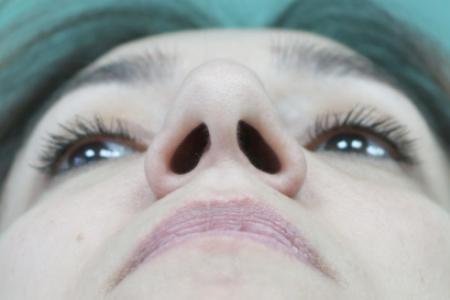 Before image 6 Case #130881 - Conventional Septorhinoplasty