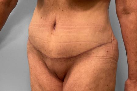 After image 2 Case #132781 - Tummy Tuck