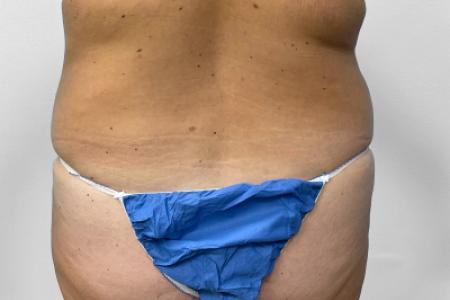 Before image 4 Case #132801 - Tummy Tuck