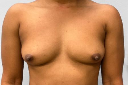 Before image 1 Case #132796 - Breast Augmentation