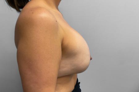 Before image 3 Case #133101 - Breast Implant Removal