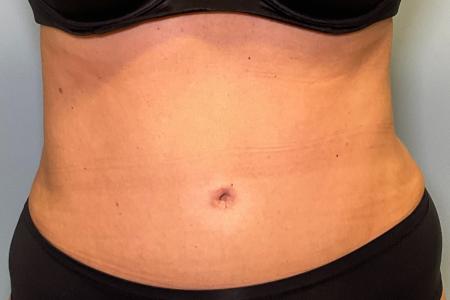 After image 1 Case #131601 - 55 y.o. female with Lipo and Tummy Tuck