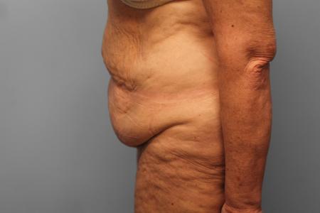 Before image 3 Case #132781 - Tummy Tuck