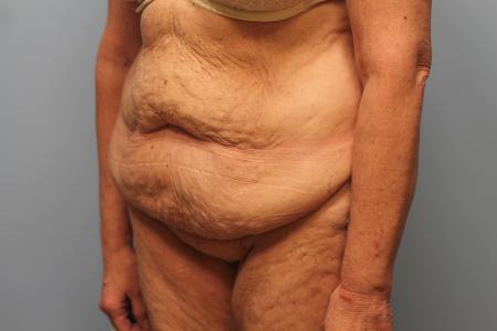 Before image 2 Case #132781 - Tummy Tuck