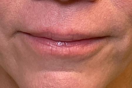 Before image 1 Case #132466 - 46 y.o. female with Lip Filler