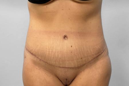 After image 1 Case #132801 - Tummy Tuck