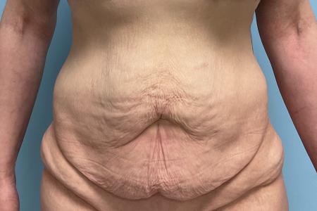 Before image 1 Case #133556 - 43 y.o. female with Tummy Tuck