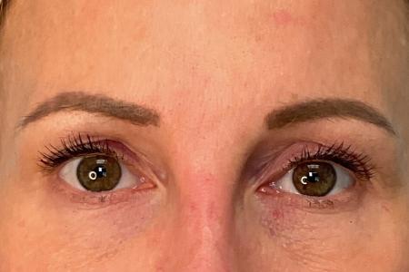 After image 1 Case #133301 - 45 y.o. female with Upper Blepharoplasty