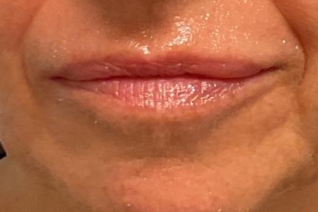 Before image 1 Case #133576 - 58 y.o. female with Lip Filler
