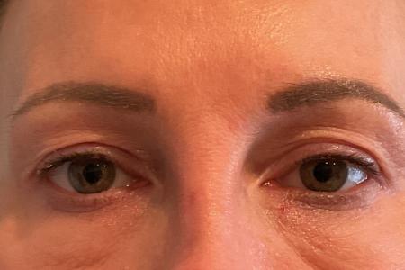 Before image 1 Case #133301 - 45 y.o. female with Upper Blepharoplasty