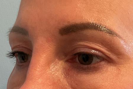 Before image 2 Case #133301 - 45 y.o. female with Upper Blepharoplasty