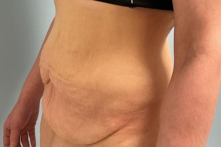 Before image 2 Case #133556 - 43 y.o. female with Tummy Tuck
