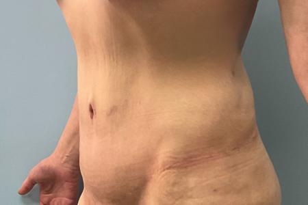 After image 2 Case #133556 - 43 y.o. female with Tummy Tuck