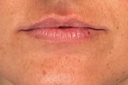 Before image 1 Case #133636 - 27 y.o. with Lip Filler