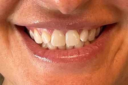 After image 2 Case #133636 - 27 y.o. with Lip Filler