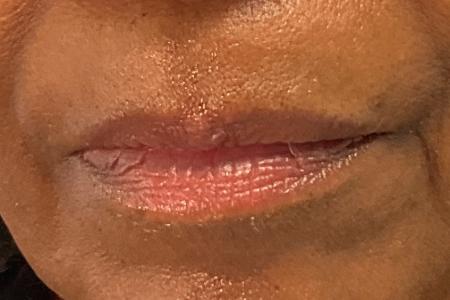 Before image 1 Case #134151 - 65 female with Lip Filler to Upper Lip