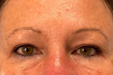 After image 1 Case #134226 - 59 y.o. female with Upper Eyelid Surgery